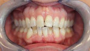 Invisalign Aberdeen